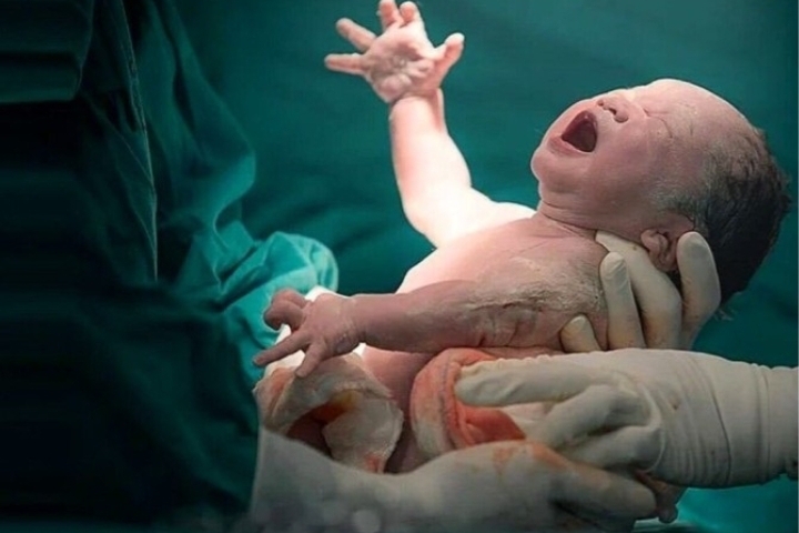 زایمان موفقیتآمیز مادر مبتلا به تومور مغزی در گیلان